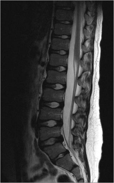 Spinal Cord Sag.png